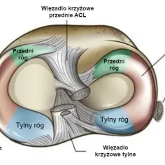 Pozioma szczelina łąkotki przyśrodkowej: Jak leczyć? Porady